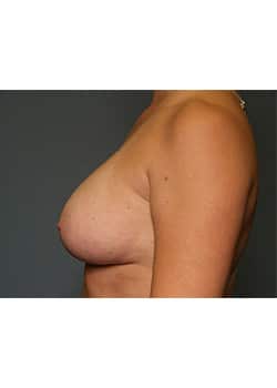 Breast Augmentation
