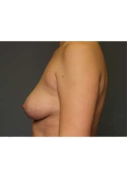 Breast Augmentation
