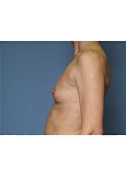 Breast Augmentation
