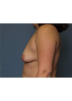 Breast Augmentation