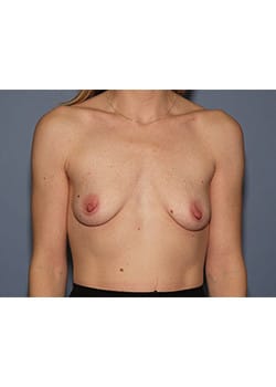Before Image: Breast Augmentation - front