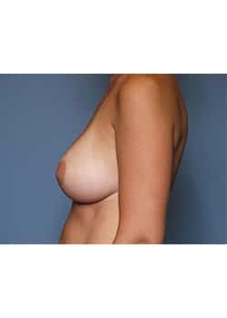 Breast Augmentation