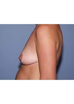 Breast Augmentation