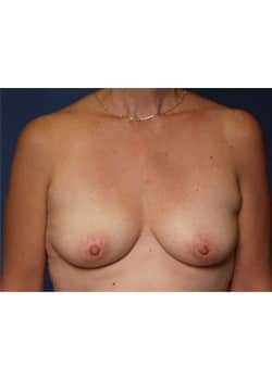 Before Image: Breast Augmentation - front