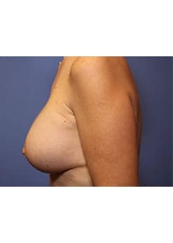 Breast Augmentation