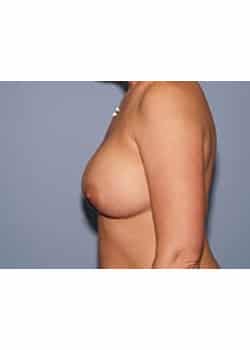 Breast Augmentation