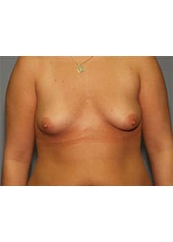 Before Image: Breast Augmentation