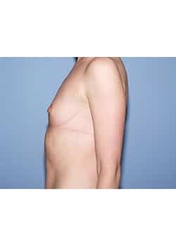 Breast Augmentation