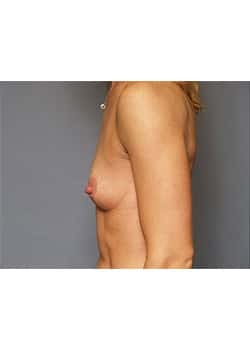 Breast Augmentation