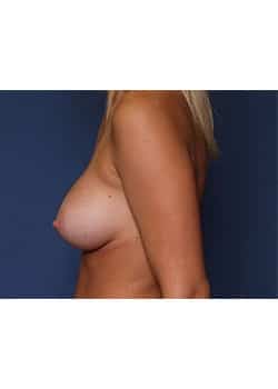 Breast Augmentation