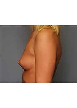 Breast Augmentation