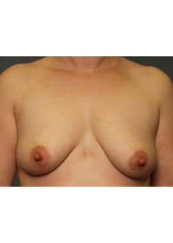 Breast Augmentation