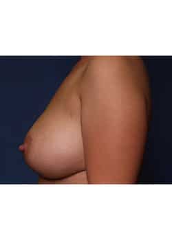 Breast Augmentation