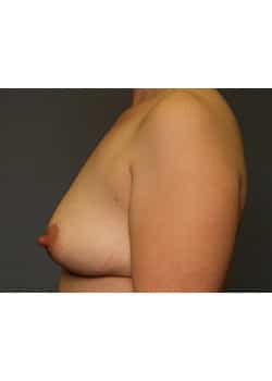 Breast Augmentation