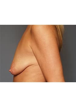 Breast Lift