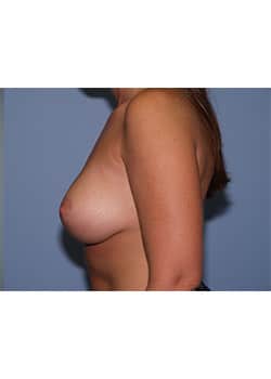 Breast Lift