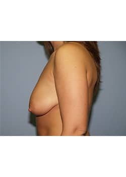 Breast Lift