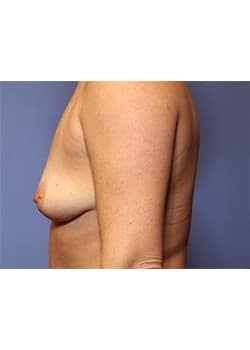 Breast Lift