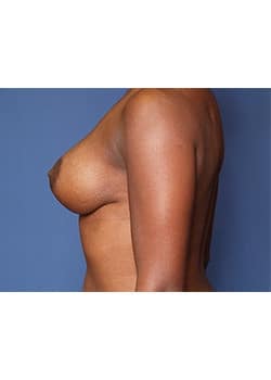 Breast Lift