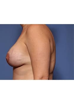 Breast Lift