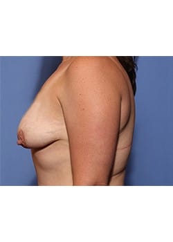 Breast Lift