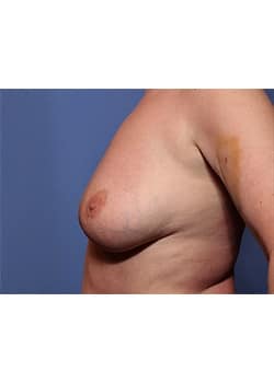 Before Image: Breast Lift - other