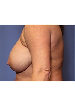Breast Lift