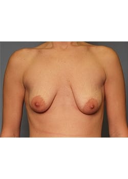 Breast Lift