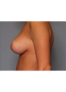 Breast Lift
