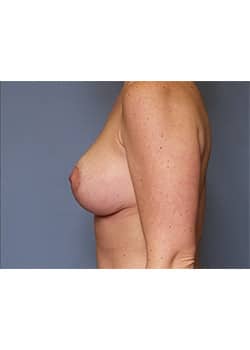 Breast Lift
