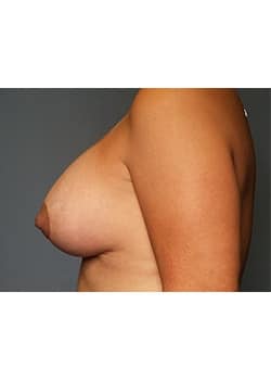 Breast Lift