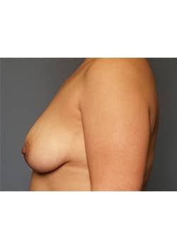 Breast Lift
