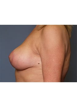 Breast Lift