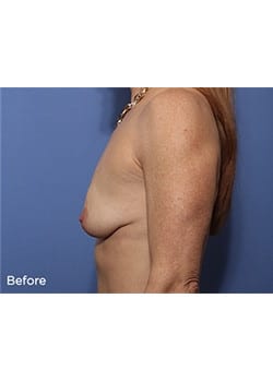 Breast Lift with Augmentation
