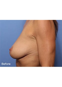 Before Image: Breast Lift with Augmentation - other
