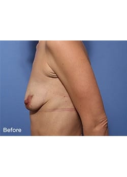 Breast Lift with Augmentation