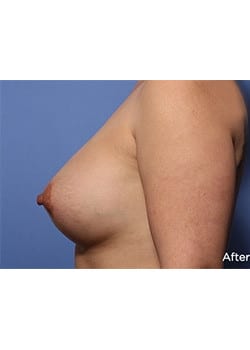 Breast Lift with Augmentation
