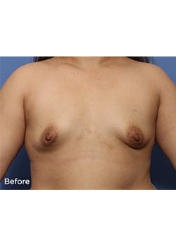 Breast Lift with Augmentation
