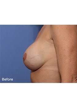 Breast Revision