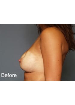 Breast Revision