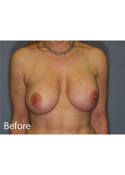 Breast Revision