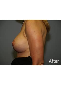 Breast Revision