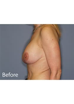 Breast Revision