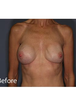 Before Image: Breast Revision - front