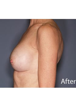 Breast Revision