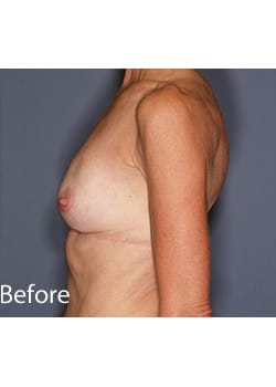 Breast Revision
