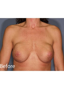 Breast Revision