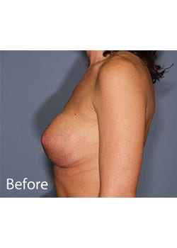 Breast Revision