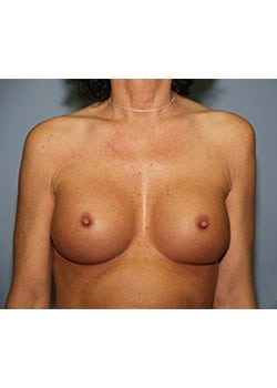 After Image: Breast Revision - front