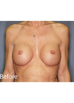 Before Image: Breast Revision - front